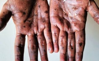 Primer caso de nueva variante de mpox en Reino Unido