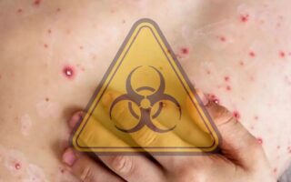 OMS declara emergencia mundial por Mpox en África (video)